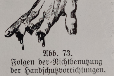Die Zeichnung einer Hand, an der die Kuppen von Zeige-, Mittel- und Ringfinger durch die Nichtbenutzung der Handschutzvorrichtungen beim Schieben von Förderwagen abgeschlagen worden sind